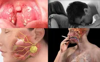 Các dấu hiệu của bệnh ung thư vòm họng