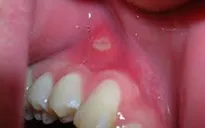 Tự chăm sóc viêm niêm mạc miệng trong điều trị ung thư