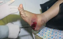 Việt Nam có khoảng 3,5 triệu người mắc đái tháo đường