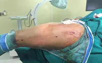 Phương pháp kết xương kín đóng đinh nội tủy