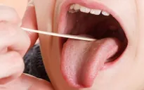4 nguyên nhân dẫn đến lưỡi màu cam