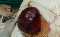 Cụ bà 90 tuổi bị viêm phúc mạc do u nang buồng trứng xoắn vỡ