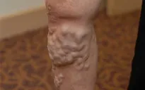 Những sai lầm khi điều trị suy giãn tĩnh mạch