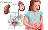 Viêm đường tiết niệu ở trẻ em