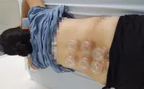 Điều trị đau cột sống thắt lưng bằng giác hơi kết hợp xoa bóp bấm huyệt