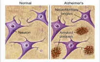 Tìm ra cách phát hiện Alzheimer trước 15 năm