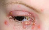 Các bệnh về mắt liên quan đến “chuyện ấy”