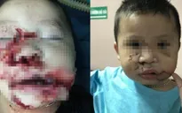 Bé trai 2 tuổi bị chó cắn nát mặt