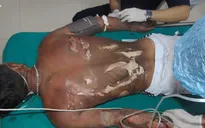 Cấp cứu cho bệnh nhân bị bỏng xăng nguy kịch tính mạng