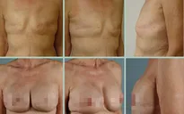 Biến chứng nào có thể xảy ra sau phẫu thuật ung thư vú?
