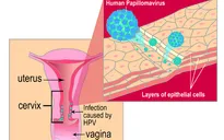 Vi rút HPV có nguy hiểm không?