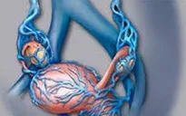 Giãn tĩnh mạch thừng tinh - chứng bệnh có thể gây vô sinh