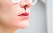 Nên làm gì khi bị chảy máu mũi?