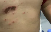 Gia tăng nhiễm trùng da ở trẻ em