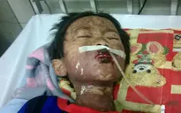 Dị ứng với thức ăn dễ gây sốc phản vệ và tử vong