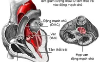 Cứu sống mẹ con sản phụ bị bệnh tim nặng kèm theo khối u xơ tử cung nặng 4kg