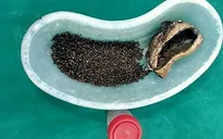 4.100 viên sỏi trong túi mật của một bệnh nhân ở Ấn Độ