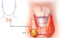 Nổi hạch to ở cổ - Dấu hiệu cảnh báo ung thư tuyến giáp