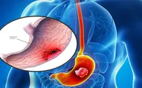 Tỷ lệ ung thư dạ dày ở Việt Nam