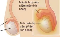 Viêm tinh hoàn: Biến chứng nguy hiểm nếu không điều trị kịp thời