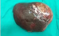 Ca bệnh hiếm: Khối u gan 5kg ở bệnh nhân u cơ mỡ mạch gan