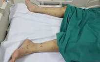 Vì sao viêm não mô cầu lại nguy hiểm?