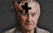 Những nguyên nhân gây bệnh Alzheimer