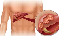 Buồn nôn kéo dài - cảnh giác với ung thư gan