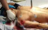 "Báo động đỏ nội viên" cứu bệnh nhân bị đâm xuyên ngực, phạm đến tủy sống