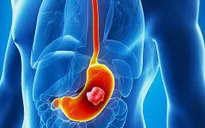 12 nguyên nhân gây ung thư dạ dày được các chuyên gia cảnh báo