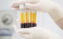 Thay huyết tương cứu bệnh nhân viêm tụy cấp do tăng mỡ máu