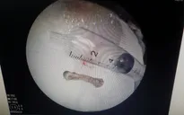 Mẩu xương gà dài 4cm "lẩn trốn" cả năm trong phế quản nữ bệnh nhân
