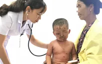Bé trai 2 tuổi bị viêm da mủ toàn thân, loét hết mặt vì tắm nước lá