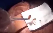 Gián chui vào tai bệnh nhân, bác sĩ phải dùng kẹp gắp