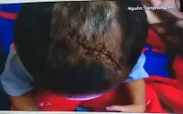 Bình Dương: Điều tra vụ bé trai 3 tuổi nghi bị bạo hành