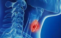 Các dạng ung thư tuyến giáp và phương pháp điều trị
