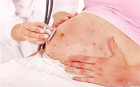 Bệnh thủy đậu ảnh hưởng trên thai kỳ như thế nào?