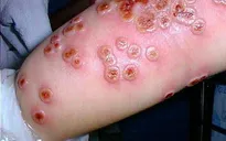 Góc giải đáp: Bệnh đậu mùa khỉ khác gì đậu mùa thường?