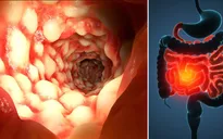 Chế độ ăn uống cho người bị viêm đại tràng