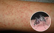 Lào: Gần 1.100 trường hợp mắc sốt xuất huyết, 2 người thiệt mạng