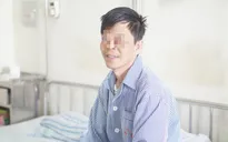 Lồi mắt nặng do biến chứng bướu basedow