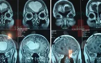 Trầm cảm, mất ngủ: Phát hiện u màng não trán