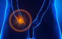 Ngại dịch COVID-19, trẻ hoại tử ruột vì viêm phúc mạc ruột thừa
