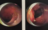 Mới 29 tuổi, người đàn ông bị polyp chằng chịt trong đại tràng