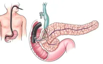 Các triệu chứng dễ bỏ qua của ung thư tụy