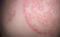Bệnh nấm da vào mùa hè