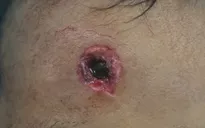 Chơi súng tự chế, trẻ bị đạn bắn găm sâu vào trán