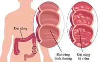 4 nguyên tắc "vàng" đẩy lùi bệnh viêm đại tràng