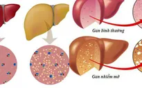 Gan nhiễm mỡ ở trẻ em - Cha mẹ đừng chủ quan!