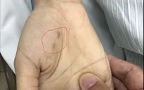 Chủ quan không tiêm phòng: Một bác sĩ thú y tử vong do bệnh dại